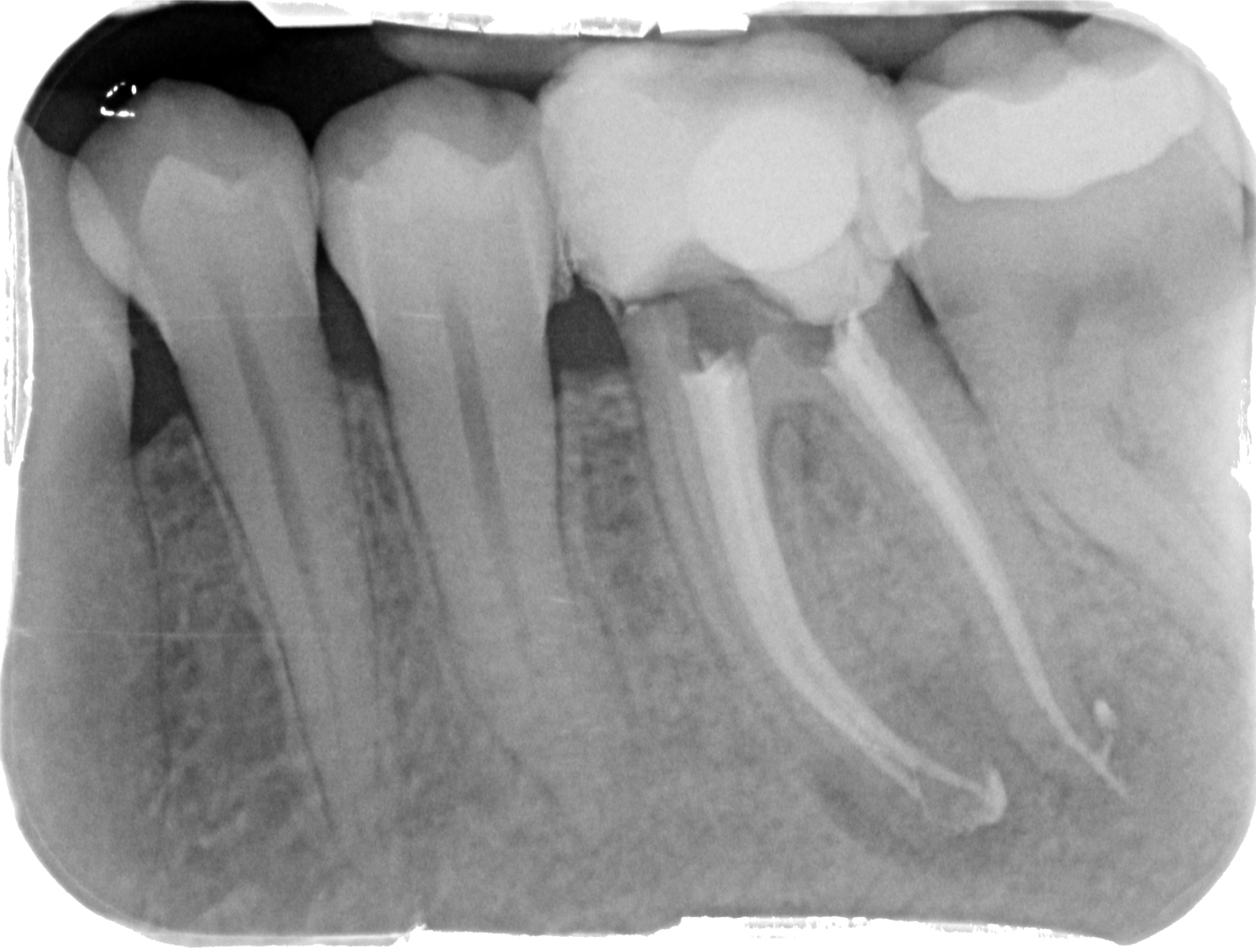 Endodoncia-02.JPG